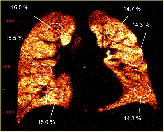 distribution of deposition in lungs